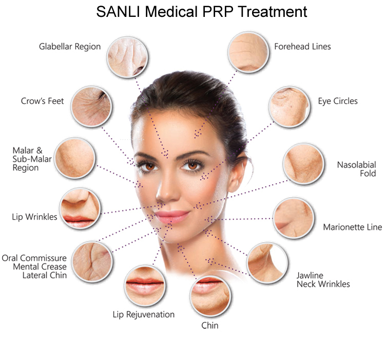 SANLI PRP Treatment News