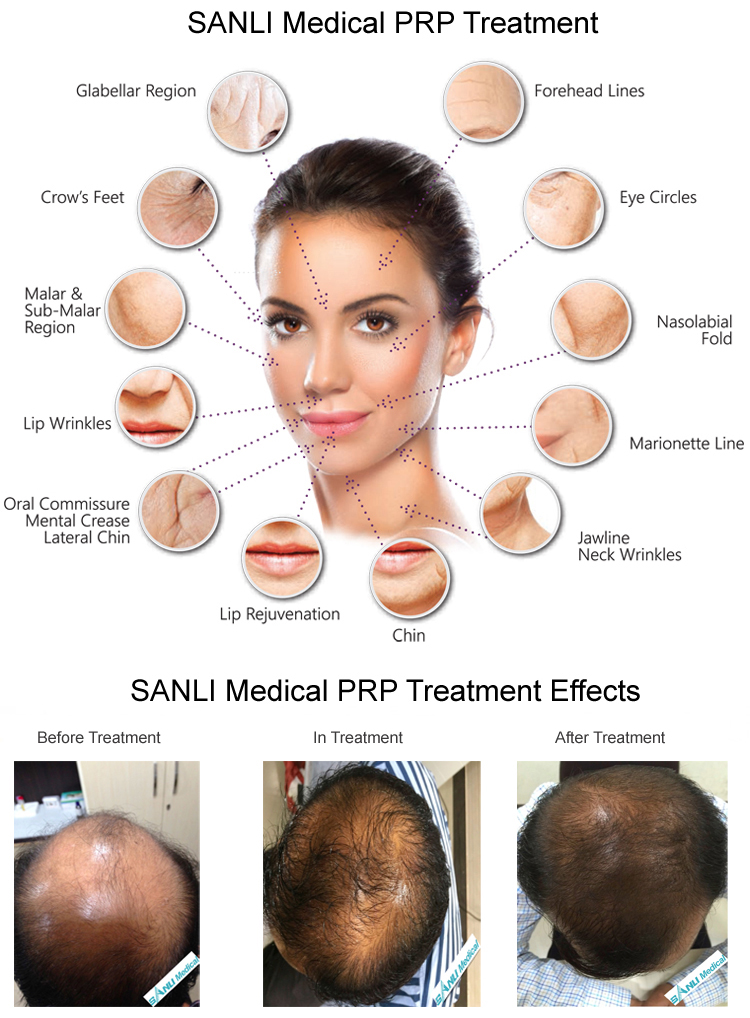 SANLI PRP Treatment